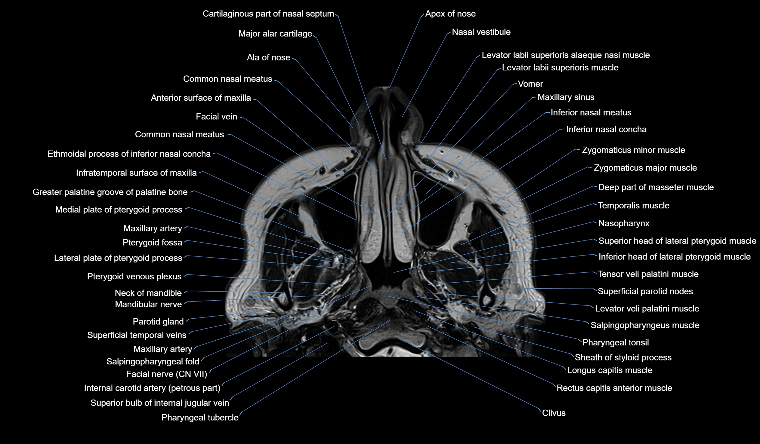 MRI face & paranasal sinuses(PNS) labelled  axial  cross sectional anatomy 3T radiology  image -00008.webp